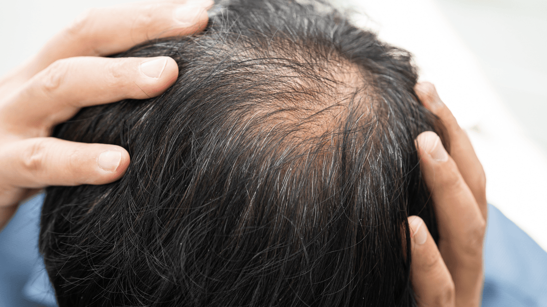 Calvitie : causes, symptômes et traitements efficaces chez l’homme et la femme - AUBE