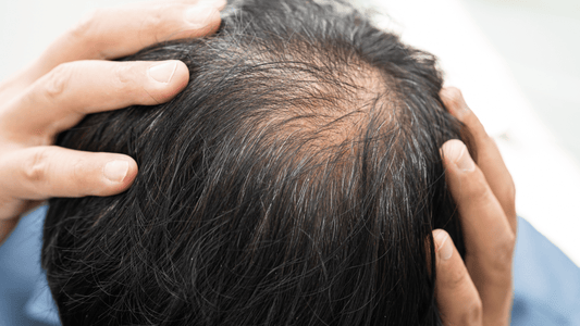 Calvitie : causes, symptômes et traitements efficaces chez l’homme et la femme - AUBE